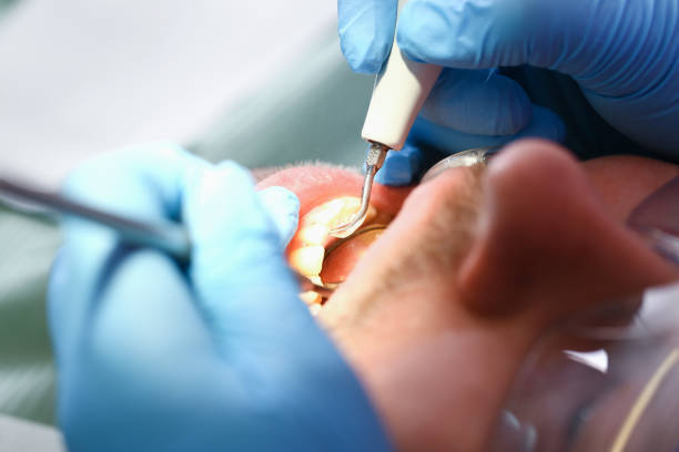 Best Emergency Tooth Extraction in Warson Woods, MO